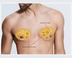 gynaecomastia